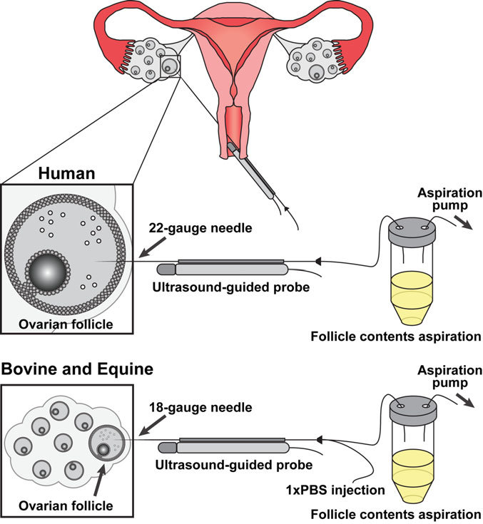 ICSI Treatment